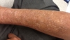 Derm Dx: White spots on sun-damaged skin