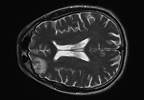 Traumatic brain injury in youth athletes Traumatic brain injury in youth athletes