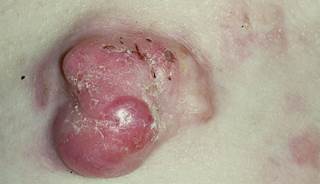 September 2013 Dermatology CME/CE September 2013 Dermatology CME/CE