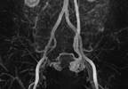 Options for pelvic congestion syndrome Options for pelvic congestion syndrome