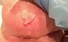 Obstructive Sleep Apnea Medication Leads to Skin Rash in Patient Obstructive Sleep Apnea Medication Leads to Skin Rash in Patient