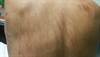 Case Study: What's Causing this Linear Rash in a Patient with Hodgkin Lymphoma? Case Study: What's Causing this Linear Rash in a Patient with Hodgkin Lymphoma?