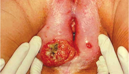 Wart on Face Pictures | MedicalPictures.net