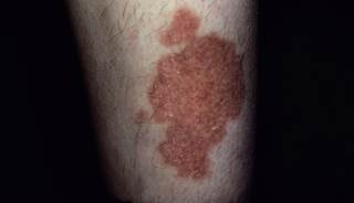 long term itchy rash on one shin only - Dermatology - MedHelp