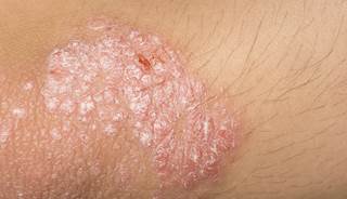 Novel therapy effective for plaque psoriasis Novel therapy effective for plaque psoriasis