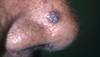 The two most common forms of skin cancer The two most common forms of skin cancer