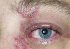 Stroke risk rises with shingles attack Stroke risk rises with shingles attack
