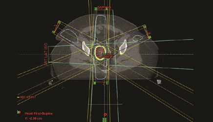 Figure 3. The same radiation treatment regimen was used for the left-sided lesion as had been used for the right-sided lesion