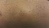 Enduring eruption of papules on the chest Enduring eruption of papules on the chest