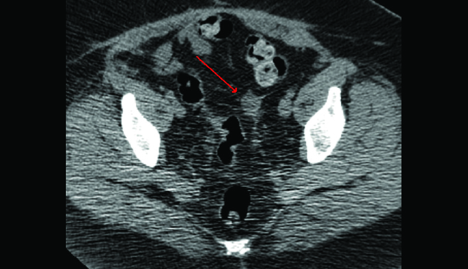 Figure 2. A similar lesion was later discovered in the patient's left lower quadrant as well.
