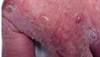 Multiple blisters on the extremities Multiple blisters on the extremities