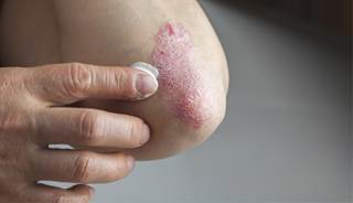 Severe psoriasis increases the risk of developing chronic kidney disease.