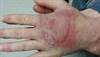 Solitary plaque on dorsal hand Solitary plaque on dorsal hand