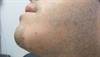 Patchy hair loss on
a bearded chin Patchy hair loss on
a bearded chin