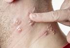Could exposure to herpes zoster actually help clinicians?
Could exposure to herpes zoster actually help clinicians?