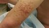 Red-brown lesions on the upper body Red-brown lesions on the upper body