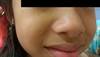 Multiple facial papules on a young girl Multiple facial papules on a young girl