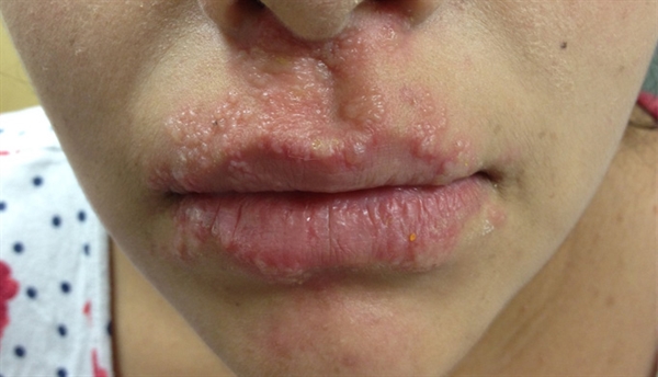 replacement of gabapentin with pregabalin in postherpetic neuralgia therapy