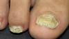 Derm Dx: Thickened toenails Derm Dx: Thickened toenails
