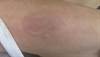 Annular plaques on the foot, shin, hand Annular plaques on the foot, shin, hand