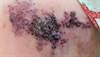 Fluid-filled lesion on a child's leg Fluid-filled lesion on a child's leg
