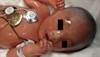 Derm Dx: Infant born in plastic film-like membrane Derm Dx: Infant born in plastic film-like membrane