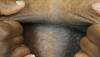 Derm Dx: Warty papules on the chest, ears Derm Dx: Warty papules on the chest, ears