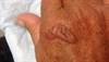 Derm Dx: Photosensitive blisters on the hands Derm Dx: Photosensitive blisters on the hands