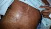 Derm Dx: Desquamating full-body rash in HIV-positive patient Derm Dx: Desquamating full-body rash in HIV-positive patient