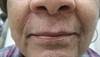 Acne-like rash around the nose and mouth Acne-like rash around the nose and mouth