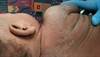 A desquamating rash on an infant A desquamating rash on an infant