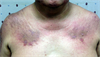 Derm Dx: Itchy rash on eyelids, chest, back, and hands Derm Dx: Itchy rash on eyelids, chest, back, and hands