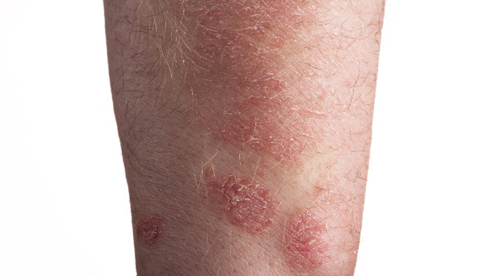 biologics-may-up-fungal-infection-risk-in-patients-with-psoriasis-the