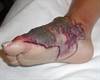 Purple plaque on foot after swim in river Purple plaque on foot after swim in river