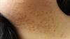 Papules on girl with Down syndrome Papules on girl with Down syndrome
