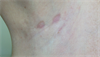 Derm Dx: Itchy rash in the groin, axilla Derm Dx: Itchy rash in the groin, axilla