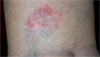 Derm Dx: Erythematous, raised plaque on calf Derm Dx: Erythematous, raised plaque on calf