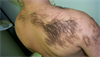 Derm Dx: Coarse hairs on the back, shoulder Derm Dx: Coarse hairs on the back, shoulder