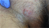 Derm Dx: Itchy rash on the groin Derm Dx: Itchy rash on the groin
