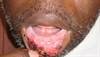Derm Dx: Denuded, crusted patches on the lower lip Derm Dx: Denuded, crusted patches on the lower lip