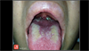 Image of the Week: Diphtheria Image of the Week: Diphtheria