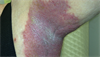 Derm Dx: Long-term, recurring rash in axillae, groin folds Derm Dx: Long-term, recurring rash in axillae, groin folds