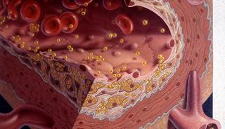 Excessive cholesterol in bloodstream (shown in illustration) can lead to atherosclerotic CVD. Excessive cholesterol in bloodstream (shown in illustration) can lead to atherosclerotic CVD.