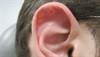 Nodule on scaphoid fossa of the ear Nodule on scaphoid fossa of the ear