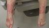 Vesiculobullous rash with atopic dermatitis Vesiculobullous rash with atopic dermatitis