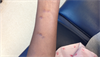 Derm Dx: Purplish bumps on the forearm Derm Dx: Purplish bumps on the forearm