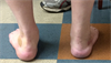 Ortho Dx: Flat footed with ankle, foot pain Ortho Dx: Flat footed with ankle, foot pain