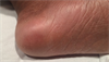 Derm Dx: Severe pain, redness in heels after cytarabine treatment Derm Dx: Severe pain, redness in heels after cytarabine treatment