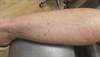Lesions with raised keratotic borders Lesions with raised keratotic borders