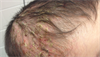 Derm Dx: Worsening scalp, axillae rash in an infant Derm Dx: Worsening scalp, axillae rash in an infant